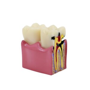 Tooth Decay Cross Section Model