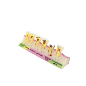 Dental Caries Classify/Evolution tooth model