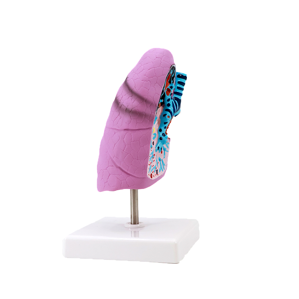 Human Pathological Lung Anatomical Model